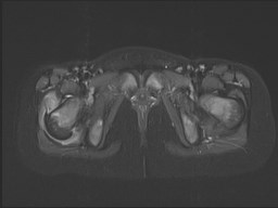 File:Neuroblastoma with bone metastases (Radiopaedia 67080-76414 Axial STIR 45).jpg