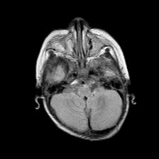 File:Neurofibromatosis type 1 (Radiopaedia 30089-30671 Axial FLAIR 5).jpg