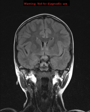 File:Neurofibromatosis type 1 with optic nerve glioma (Radiopaedia 16288-15965 Coronal FLAIR 15).jpg