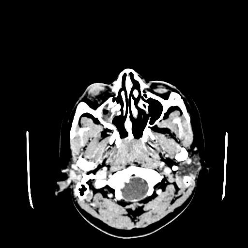 File:Neurofibromatosis type 2 (Radiopaedia 25389-25637 Axial C+ 3).jpg