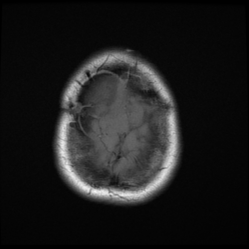 File:Neurofibromatosis type 2 (Radiopaedia 45229-49247 Axial T1 21).png