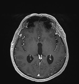 Neurofibromatosis type 2 (Radiopaedia 79097-92049 Axial T1 C+ 102).jpg