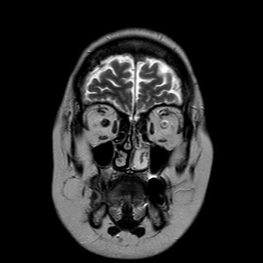 File:Neurofibromatosis type 2 (Radiopaedia 8713-9518 Coronal T2 2).jpg