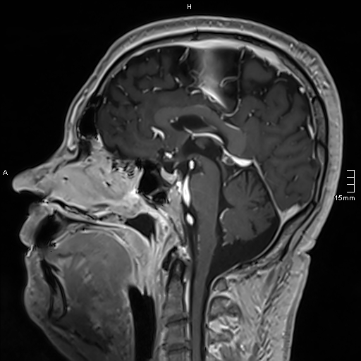 Neurosarcoidosis - involvement of the mesial temporal lobes (Radiopaedia 67429-76820 Sagittal T1 C+ 87).jpg