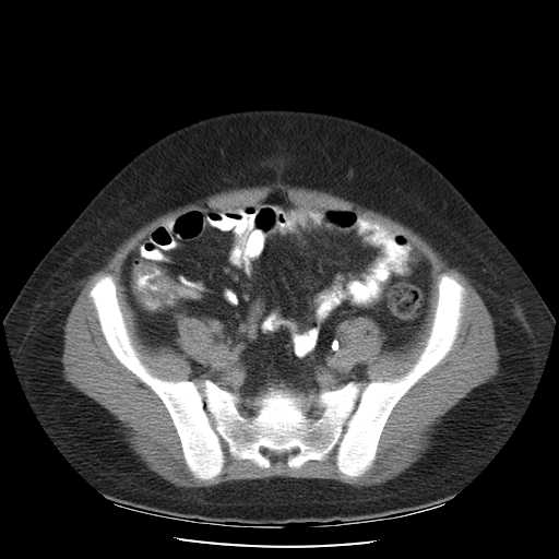 File:Non-Hodgkin lymphoma involving pelvis (Radiopaedia 21281-21197 B 48).jpg