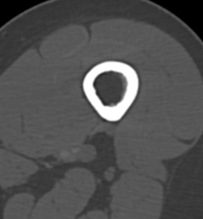 Non-ossifying fibroma - femur (Radiopaedia 82786-97042 Axial bone window 19).jpg