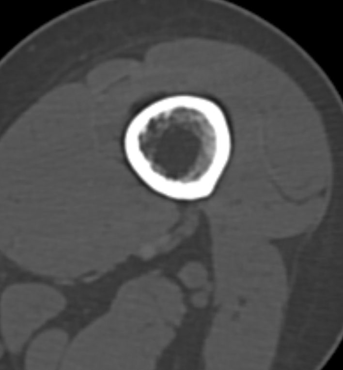 Non-ossifying fibroma - femur (Radiopaedia 82786-97042 Axial bone window 29).jpg