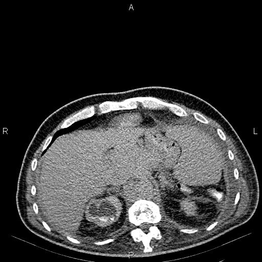 Non Hodgkin lymphoma in a patient with ankylosing spondylitis (Radiopaedia 84323-99621 Axial C+ delayed 15).jpg