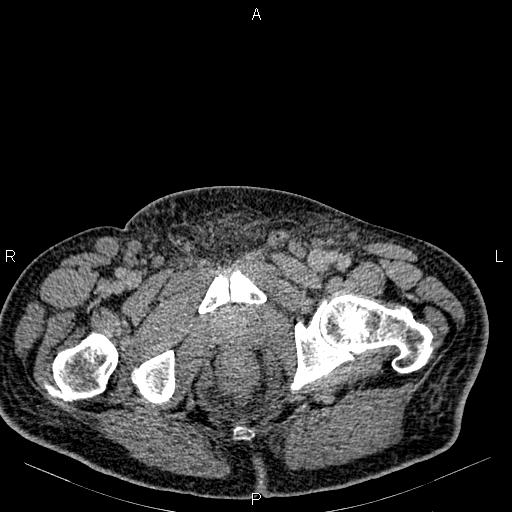 Non Hodgkin lymphoma in a patient with ankylosing spondylitis (Radiopaedia 84323-99621 Axial C+ delayed 85).jpg