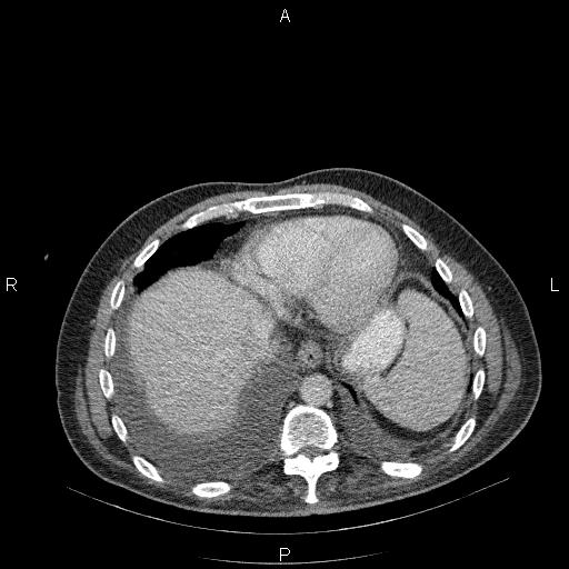 File:Non Hodgkin lymphoma in a patient with ankylosing spondylitis (Radiopaedia 84323-99624 B 23).jpg