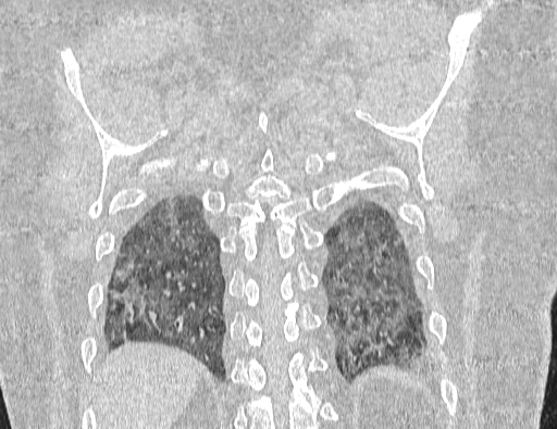 Non specific interstitial pneumonia (NSIP) (Radiopaedia 89725-106798 Coronal lung window 64).jpg