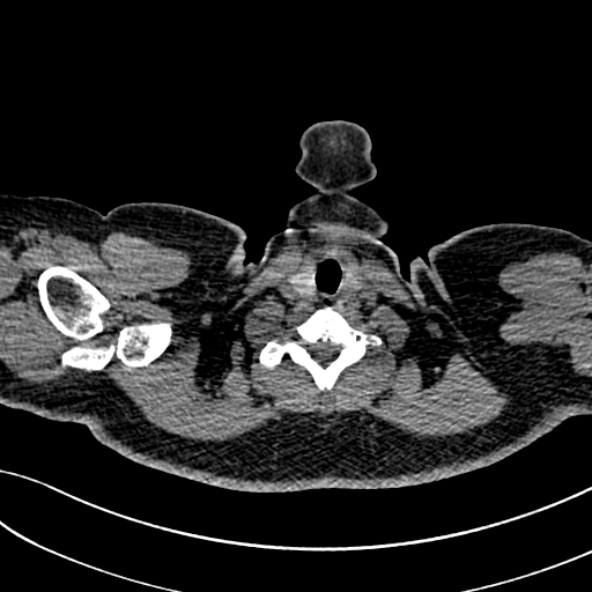 Normal CT chest- adult female (Radiopaedia 52522-58428 Axial non-contrast 2).jpg