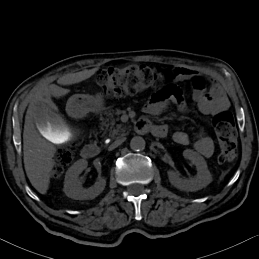 File:Normal CT intravenous cholangiogram (Radiopaedia 38199-40208 Axial IVC 44).png