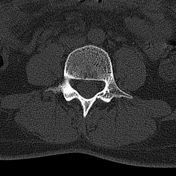 File:Normal CT lumbar spine (Radiopaedia 53981-60118 Axial bone window 47).jpg