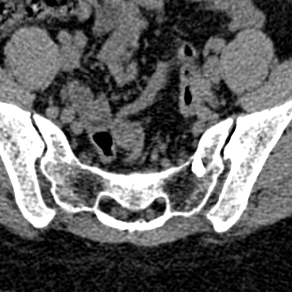 Normal CT lumbar spine (Radiopaedia 53981-60118 Axial non-contrast 103).jpg