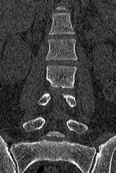 Normal CT lumbar spine (Radiopaedia 53981-60118 Coronal bone window 28).jpg