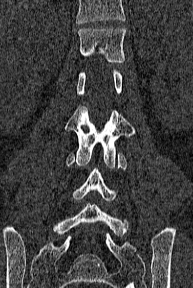 Normal CT lumbar spine (Radiopaedia 53981-60118 Coronal bone window 44).jpg