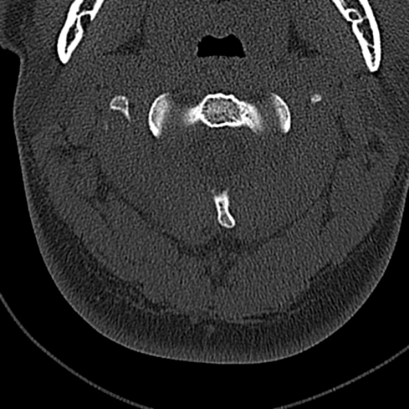 Normal CT of the cervical spine (Radiopaedia 53322-59305 Axial bone window 71).jpg