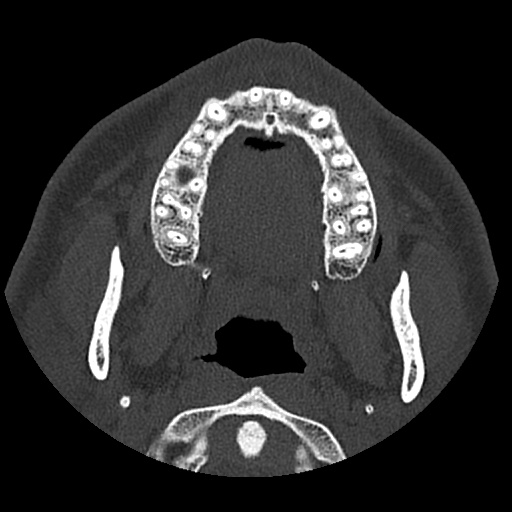 Normal CT paranasal sinuses (Radiopaedia 42286-45390 Axial bone window 100).jpg