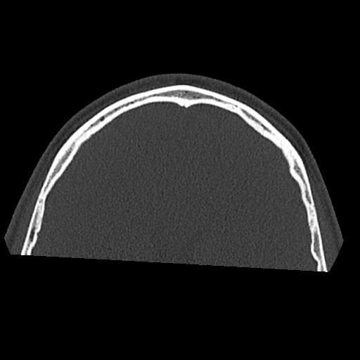 Normal CT paranasal sinuses (Radiopaedia 42286-45390 Axial bone window 5).jpg