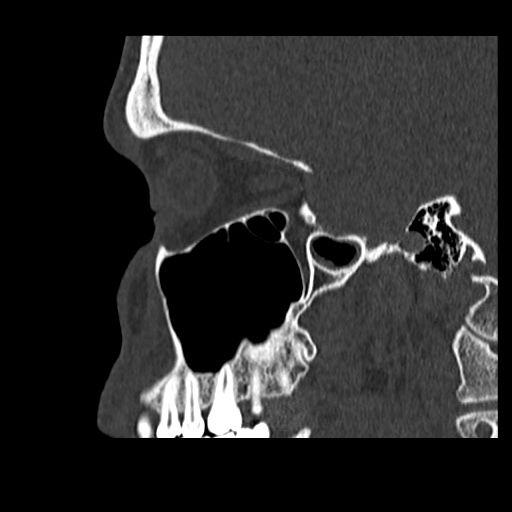 Normal CT paranasal sinuses (Radiopaedia 42286-45390 Sagittal bone window 72).jpg