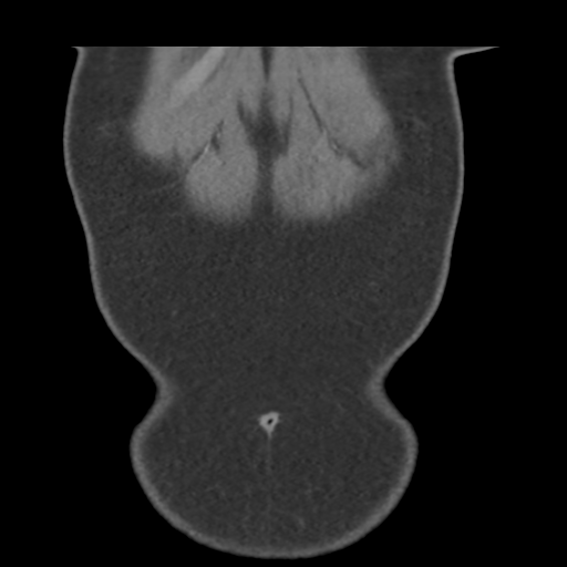 File:Normal CT renal artery angiogram (Radiopaedia 38727-40889 B 5).png