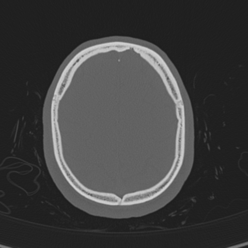 Normal CT skull (Radiopaedia 40798-43459 A 129).png