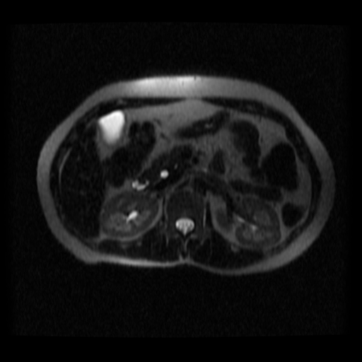 File:Normal MRCP (Radiopaedia 41966-44978 Axial T2 thins 12).png