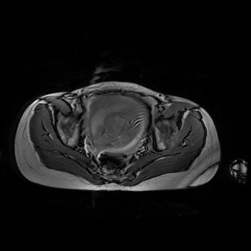 File:Normal MRI abdomen in pregnancy (Radiopaedia 88001-104541 Axial Gradient Echo 49).jpg