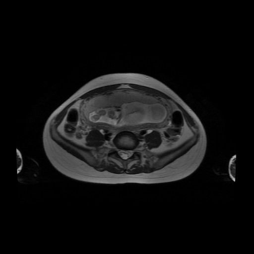 File:Normal MRI abdomen in pregnancy (Radiopaedia 88001-104541 Axial T2 46).jpg