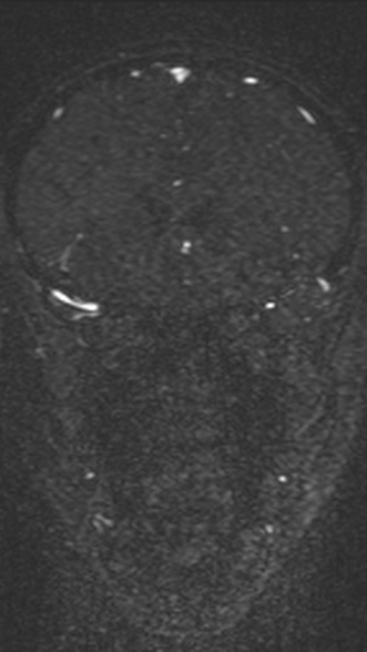 Normal MRI brain with MRV- teenager (Radiopaedia 49425-54553 Coronal MRV 91).jpg