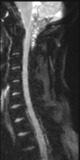 File:Normal MRI cervical spine (infection protocol) (Radiopaedia 53916-60039 Sagittal DWI 7).png
