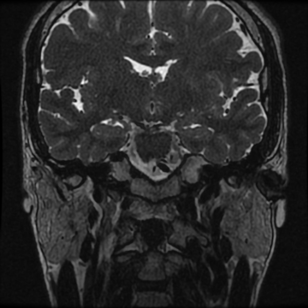 Normal MRI petrous (Radiopaedia 91317-108949 Coronal T2 28).jpg