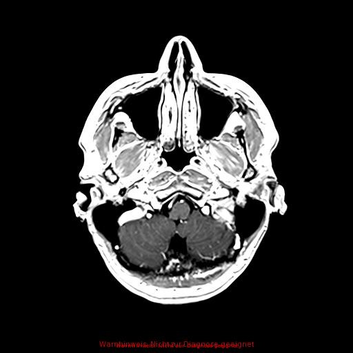 Normal adult brain MRI (non-enhanced and contrast-enhanced) (Radiopaedia 75262-86379 Axial T1 C+ 49).jpg