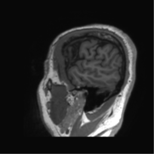 Normal brain MRI (non-focal epilepsy protocol) (Radiopaedia 53917-60040 Sagittal T1 63).png