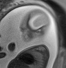 Normal brain fetal MRI - 22 weeks (Radiopaedia 50623-56050 Sagittal T2 Haste 5).jpg
