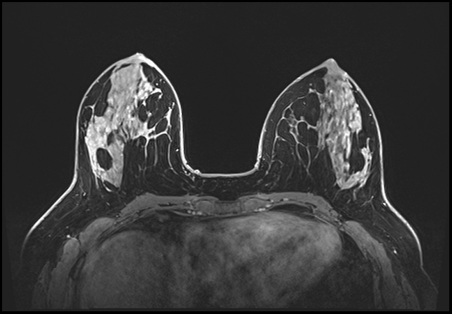 Normal breast MRI - dense breasts (Radiopaedia 80454-93850 C 94).jpg