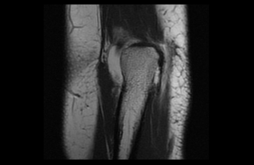 File:Normal elbow arthrograms (Radiopaedia 75550-86805 Coronal T1 4).jpg