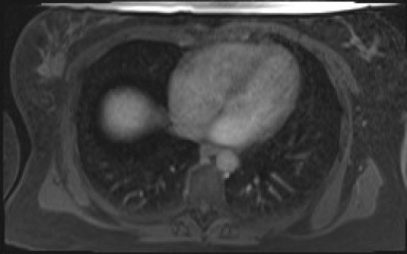 File:Normal hepatobiliary phase liver MRI (Radiopaedia 58968-66230 A 8).jpg