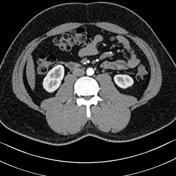 Normal kidneys on 4-phase CT study (Radiopaedia 25889-26038 B 65).jpg
