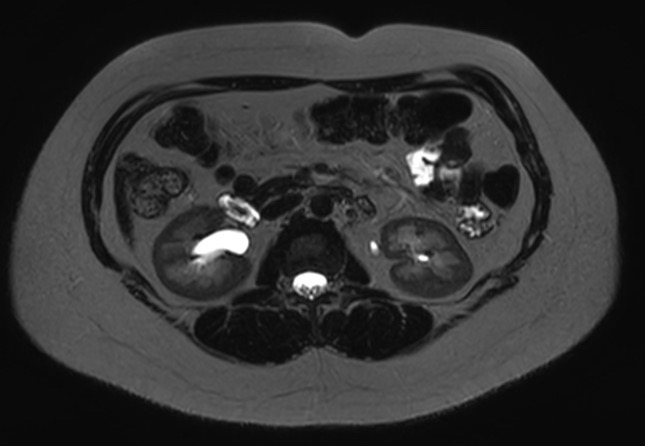 File:Normal liver MRI with Gadolinium (Radiopaedia 58913-66163 E 11).jpg
