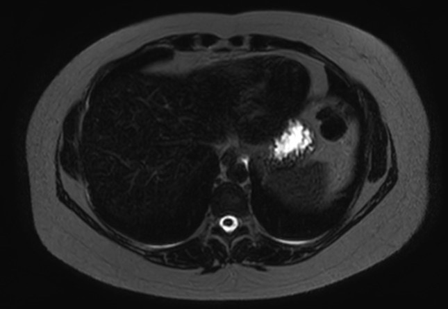 File:Normal liver MRI with Gadolinium (Radiopaedia 58913-66163 E 28).jpg
