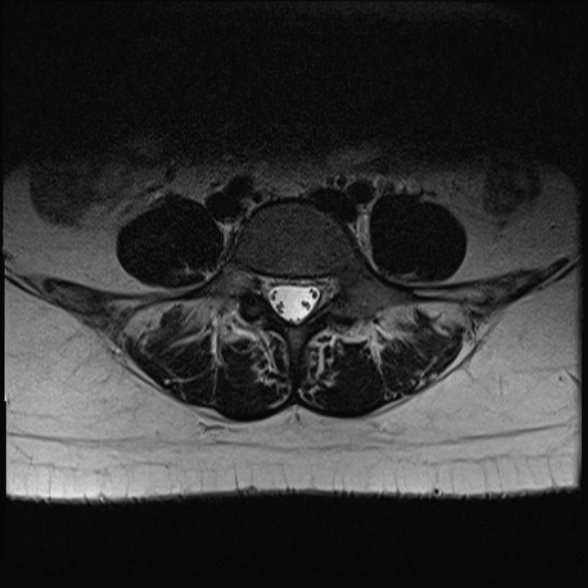 File:Normal lumbar spine MRI- 3 T (Radiopaedia 53280-59250 Axial T2 23).jpg