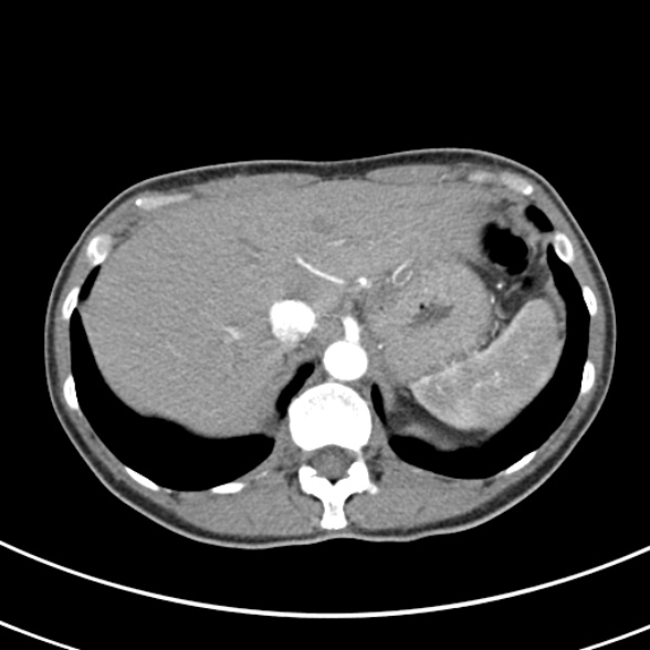 File:Normal multiphase CT liver (Radiopaedia 38026-39996 B 14).jpg