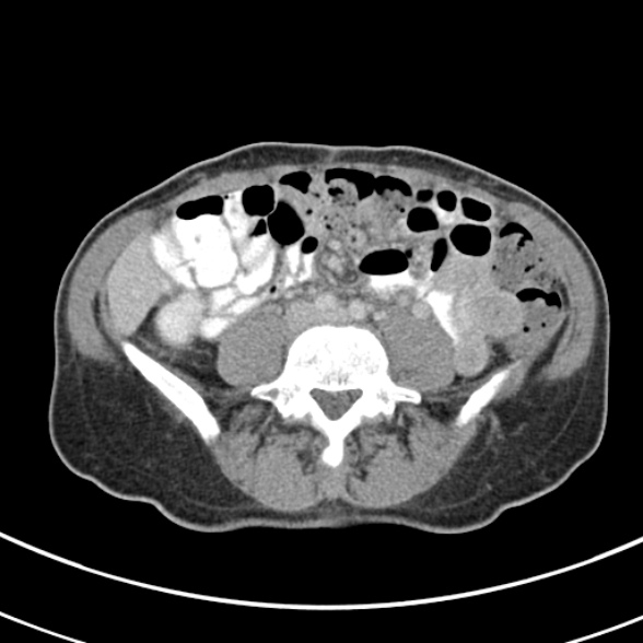 File:Normal multiphase CT liver (Radiopaedia 38026-39996 C 55).jpg