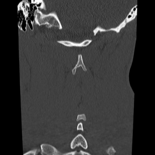 File:Normal trauma cervical spine (Radiopaedia 41017-43760 Coronal bone window 36).png