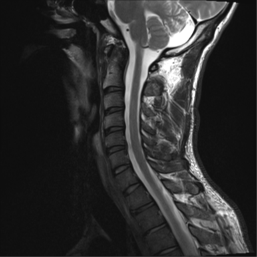 File:Normal trauma cervical spine (Radiopaedia 41017-43762 Sagittal T2 9).png