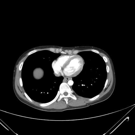 File:Nutmeg liver- Budd-Chiari syndrome (Radiopaedia 46234-50635 A 2).png
