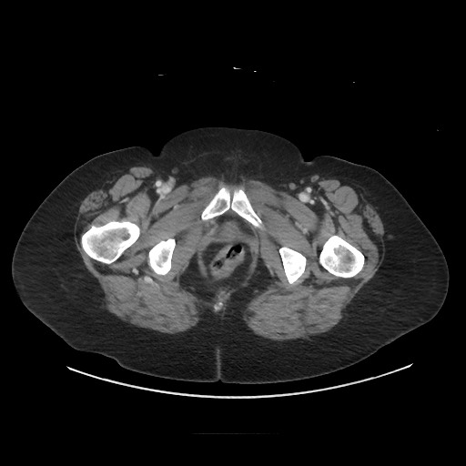 Obstructive distal colonic adenocarcinoma causing cecal perforation (Radiopaedia 86830-102989 A 195).jpg