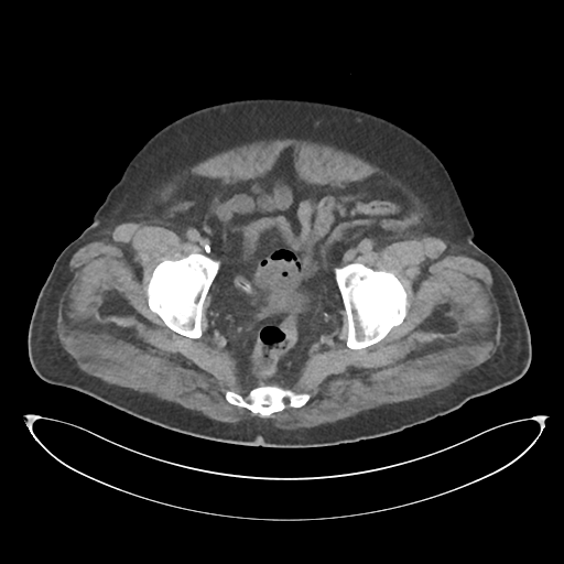 File:Obstructive pyelonephritis (Radiopaedia 46411-50844 Axial non-contrast 70).png